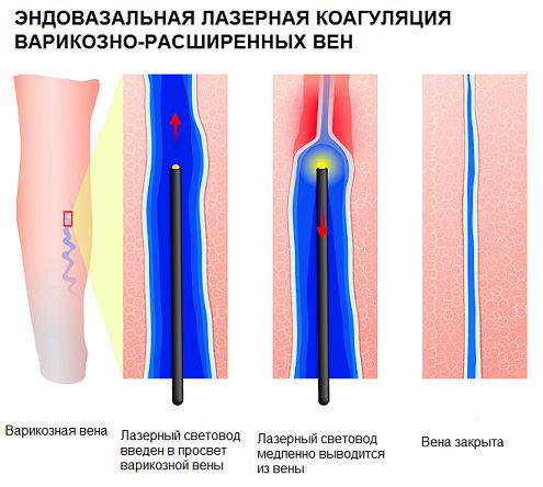 Рубрика: Eliminarea varicelor Krasnoyarsk Preț, Varicoza i scleroza recenzii